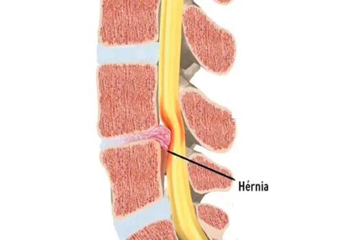 Hérnia de disco: abordagem diferente para resolver