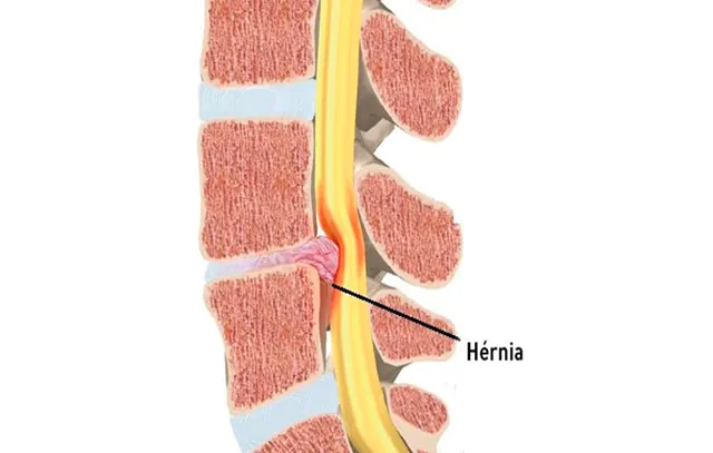 hernia-de-disco