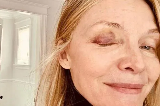 Michelle Pfeiffer aparece com olho roxo; entenda