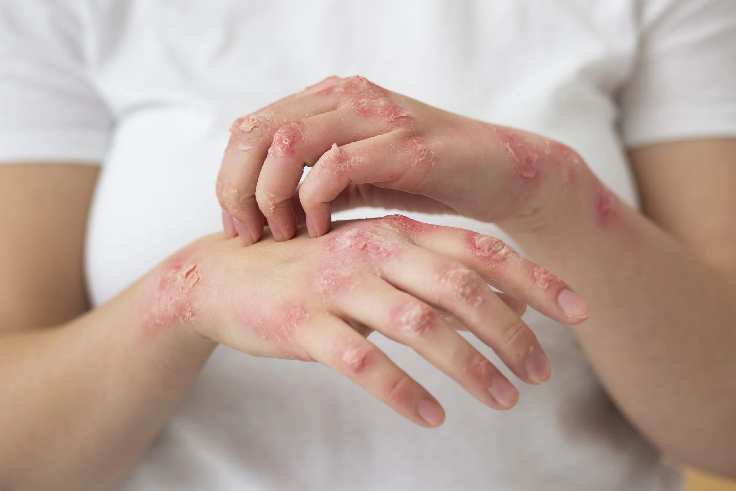 psoriase