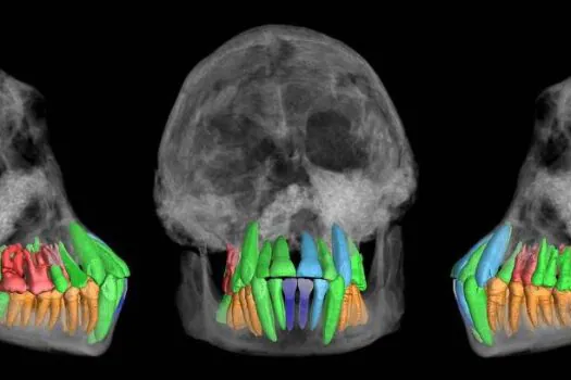 Dentes de Adolescente de 1,8 Milhão de Anos Revelam Segredos da Evolução Humana