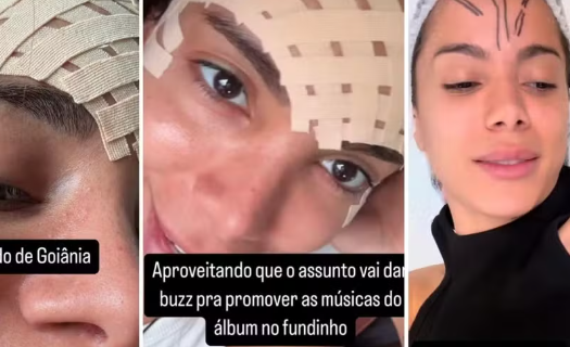 Anitta Revela Novo Procedimento Estético