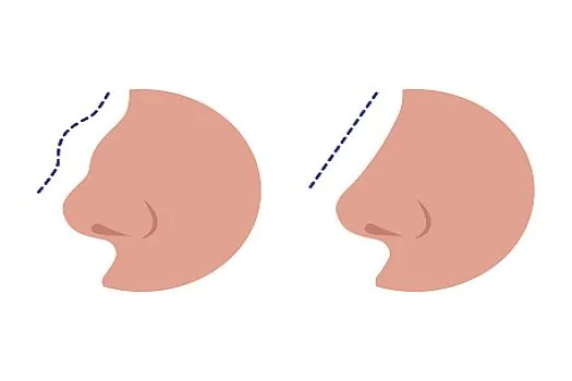 Rinoplastia: especialista esclarece sete mitos e verdades sobre o assunto