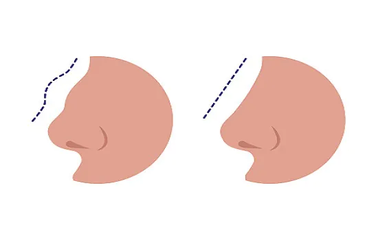 Rinoplastia: especialista esclarece sete mitos e verdades sobre o assunto