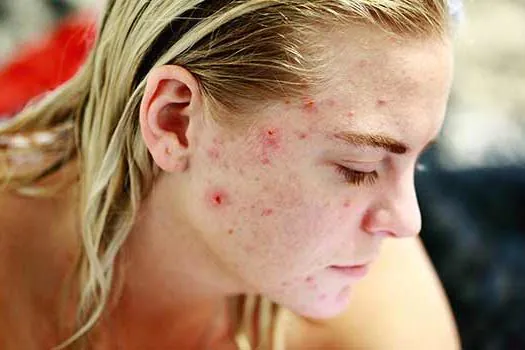 Criança e pré-adolescente podem fazer tratamento estético contra acne?