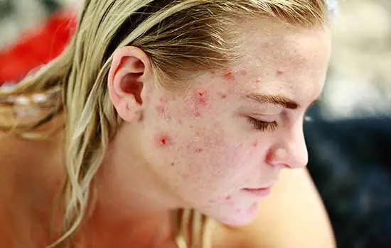 Criança e pré-adolescente podem fazer tratamento estético contra acne?