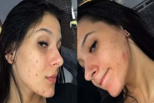 Ana Castela faz desabafo que sofre muito com acne