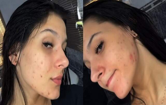 Ana Castela faz desabafo que sofre muito com acne