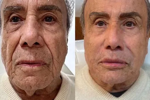 Aos 91 anos, Stenio Garcia faz harmonização facial