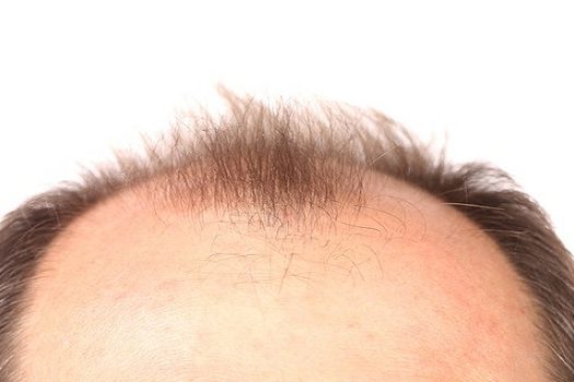 Alopecia androgenética é a causa mais comum da calvície