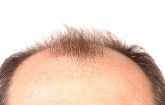 Alopecia androgenética é a causa mais comum da calvície