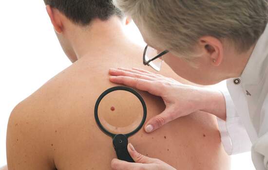 Santa Casa de SP faz ação preventiva para conter o câncer de pele