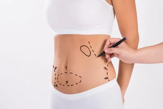 Abdominoplastia: mitos e verdades sobre uma das cirurgias mais buscadas no mundo