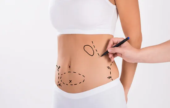 Abdominoplastia: mitos e verdades sobre uma das cirurgias mais buscadas no mundo