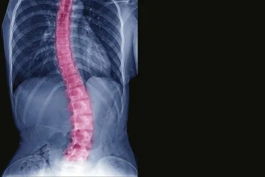 Cirurgia de escoliose: três tecnologias que melhoram a qualidade de vida do paciente