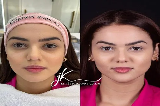 Eslovênia do BBB22 realiza harmonização facial