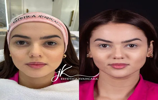 Eslovênia do BBB22 realiza harmonização facial