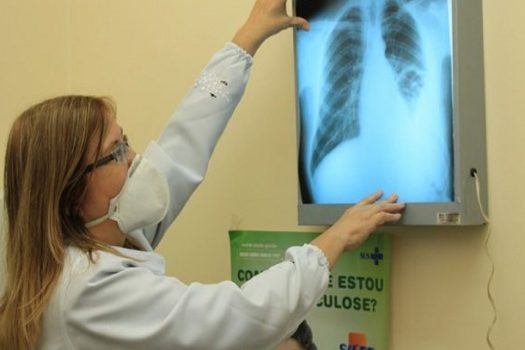 Governo cria comitê para eliminar a tuberculose