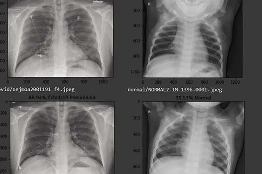 Pesquisadores da UFRRJ criam sistema que ajuda a diagnosticar covid-19