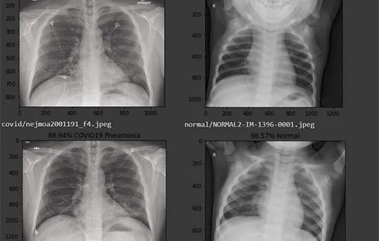 Pesquisadores da UFRRJ criam sistema que ajuda a diagnosticar covid-19