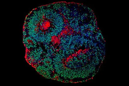 Síndrome de Pitt-Hopkins: Estudo abre possibilidades de tratamento para forma de autismo