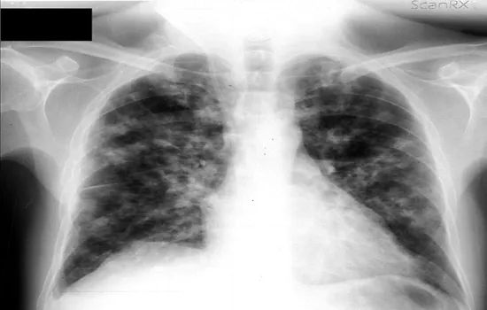 Prefeitura de SP intensifica ações de combate à tuberculose em março